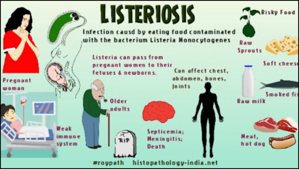 Class I Sausage Recall: Millions of Pounds Pulled Nationwide Due to Listeria Contamination 2 Common Symptoms of Listeriosis